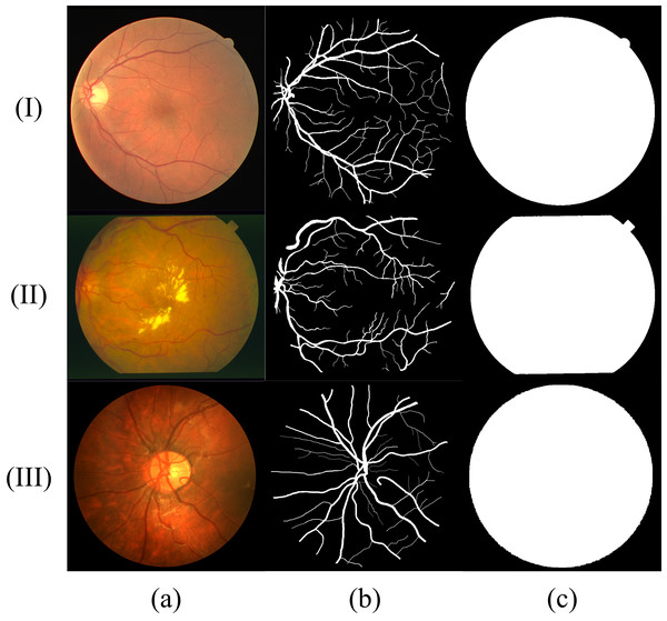 Sample fundus images in DRIVE (rows (I)), STARE (rows (II)) and CHASE (rows (III)) dataset.