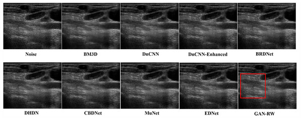 Speckle denoising results of the compared methods and the proposed method on the real ultrasound images of Lymph nodes.