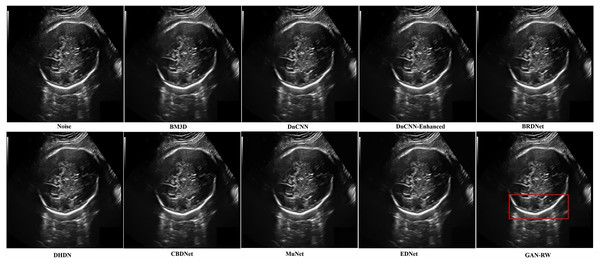 Speckle denoising results of the compared methods and the proposed method on the real ultrasound images of foetal head.