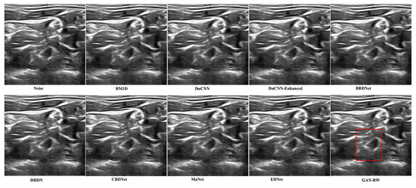 Speckle denoising results of the compared methods and the proposed method on the real ultrasound images of Brachia Plexus.