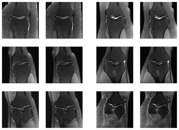 Six examples of the reconstructed images on the knee multi-coil test dataset.