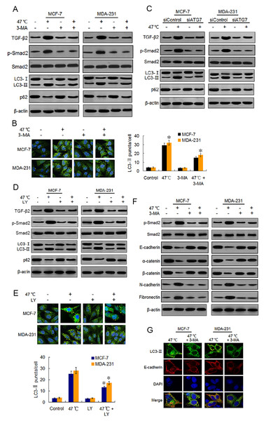 Heat-induced autophagy promotes EMT in BC cells by up-regulating TGF- β2.