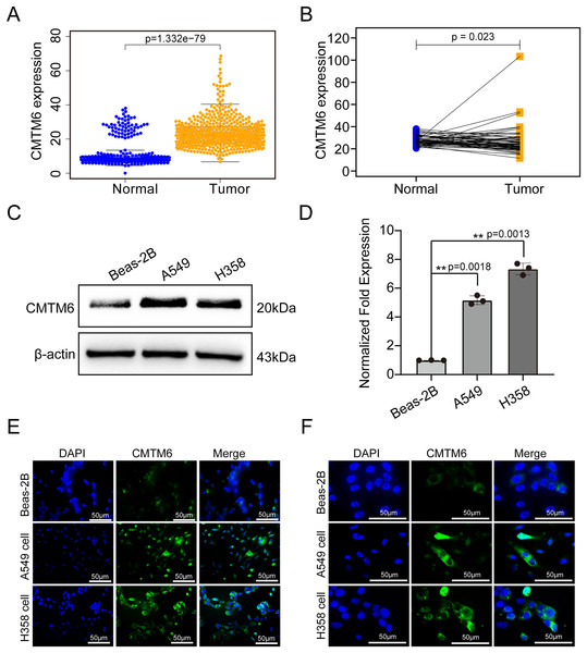 CMTM6 was significantly upregulated in LUAD based on TCGA combined with the GTEx database and cell experiments.