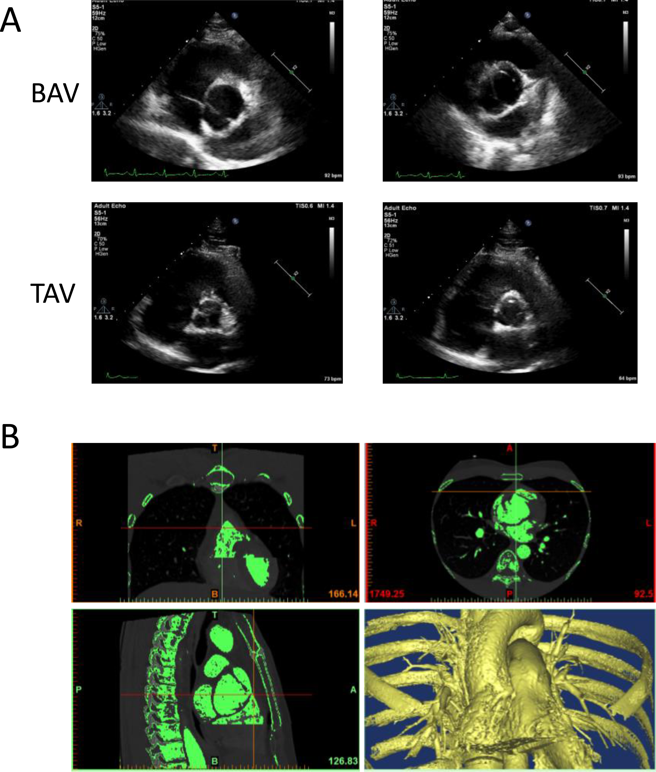 Clinical Applications of Strain Imaging in Aortic Valve Disease