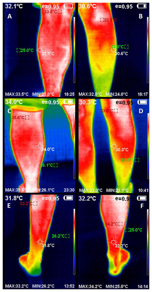 Infrared thermography images of the triceps surae complex, including left (A) and right (B) lateral gastrocnemius, left (C) and right (D) medial gastrocnemius, and left (E) and right (F) soleus muscles, including the thermal values of the region of interest.