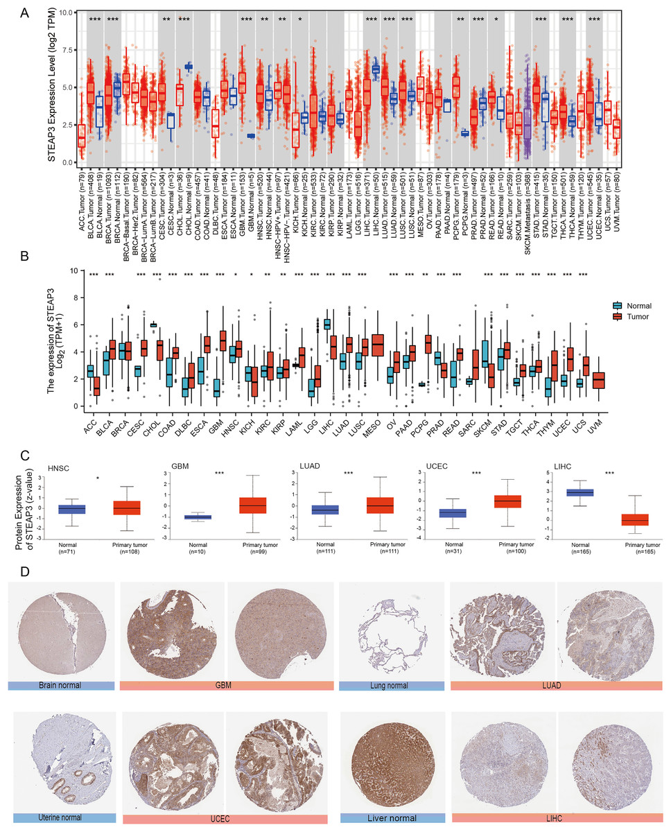 High expression of six-transmembrane epithelial antigen of prostate 3 ...