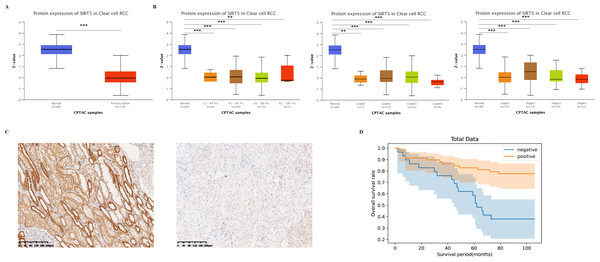 SIRT5-associated clinical pathology characteristics of patients with ccRCC.