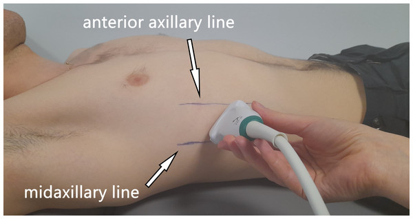 Illustration showing the ultrasound probe placement and orientation (parallel to the ribs).