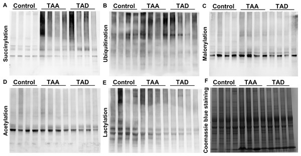 Protein lysine succinylation significantly increased in TAA and TAD tissues.