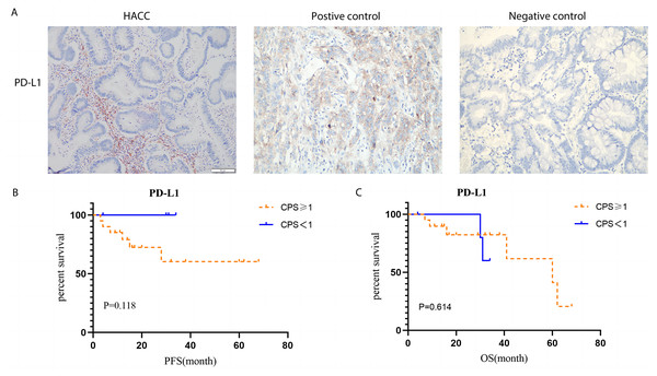 PD-L1 expression by Immunohistochemistry staining and Kaplan–Meier survival analysis of PD-L1 expression based on CPS.