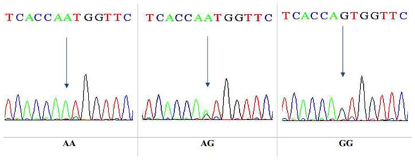 DNA sequencing of the forward strand of Ser680Asn polymorphisms (AA, AG, and GG).