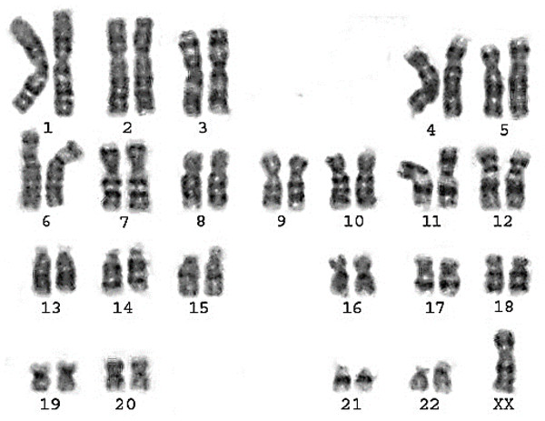 Karyotype of pure turner monosomy X: 45,X.