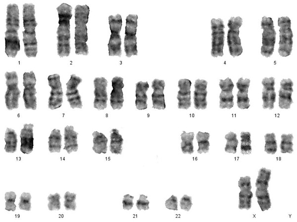 Karyotype of isochromosome of long arm of X: 46,Xi (Xq).