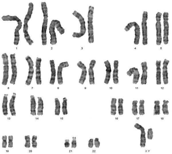 Sex reversal karyotype: 46,XY.