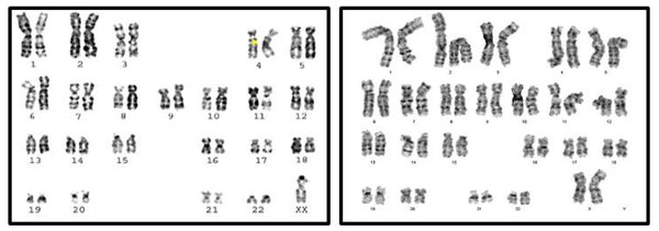 Karyotype of monosomy X (45,X) and (46,XX).