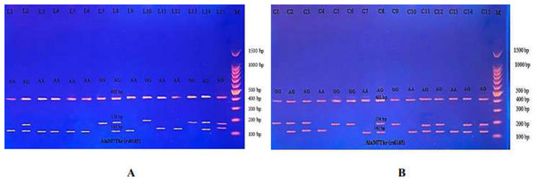 Electrophoretogram of DNA fragments for Ala307Thr polymorphisms after digestion with AhdI restriction enzymes.