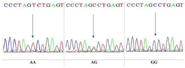 DNA sequencing of the forward strand of Ala307Thr polymorphisms (AA, AG and GG).