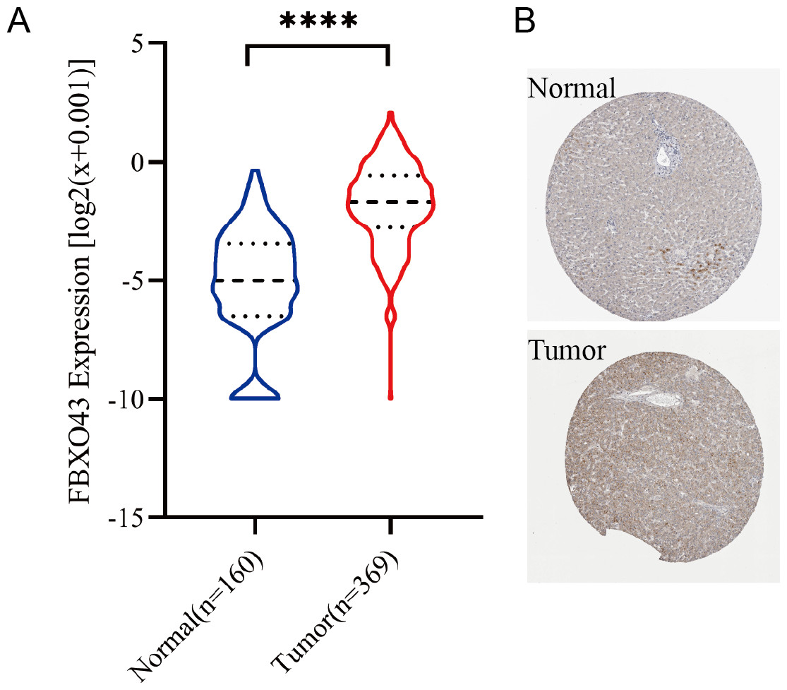 Clinical Significance Of FBXO43 In Hepatocellular Carcinoma And Its ...