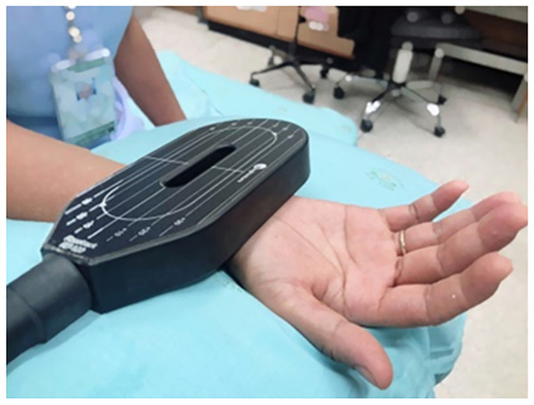 Set-up of rPMS therapy.