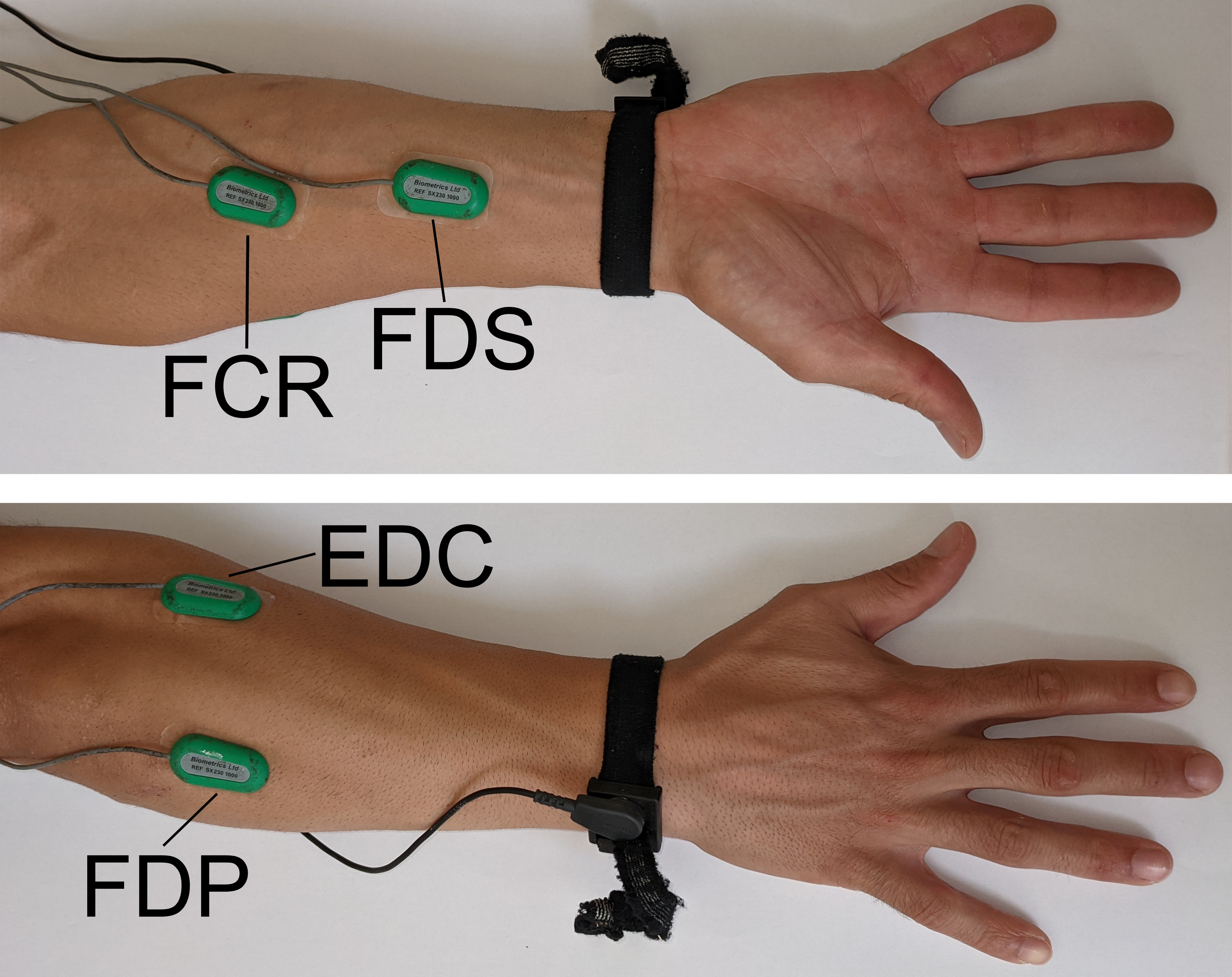 Upper/Outer Forearm Electrode Pad Placement  Extensors of Wrist & Fingers  Electrode Images/Video