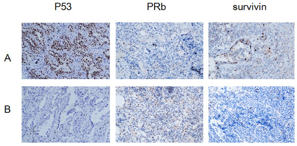 Expression of P53, PRb and surviving: HR-HPV LUAD group (A), non- HR-HPV LUAD group (B), IHC ×200.