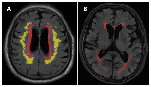 (A) Distribution of deep white matter hyperintensities (DWMH) and periventricular white matter hyperintensities (PVWMH). (B) An example of the white matter hyperintensities (WMH) quantitative assessment in one of the normal cognitive Aβ- subject.