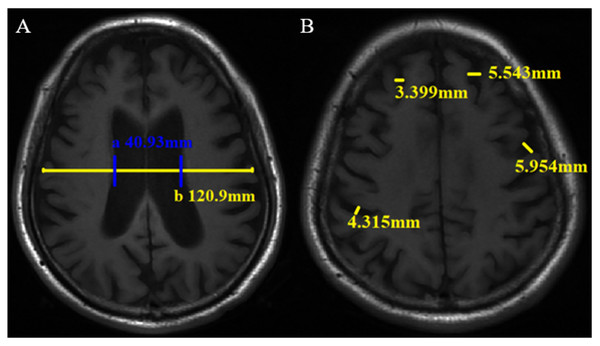 Linear measurement method of brain atrophy on axial T1WI. The minimum distance of lateral wall of the bilateral lateral ventricle (a) and transverse brain diameter at the same level (b) were measured (A), then lateral ventricle body index (LVBI) was obtained. In this case, LVBI = 2.95. Sulci width (B).