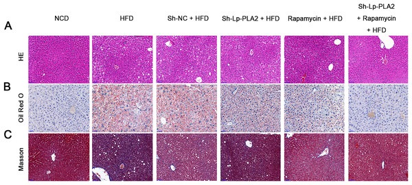 Silencing of Lp-PLA2 and promoting of autophagy alleviates liver lipid and collagen accumulation in HFD-induced NASH mice.