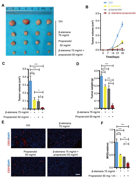 Combinatorial treatment of β-elemene and propranolol inhibited growth and angiogenesis of hemangioma.