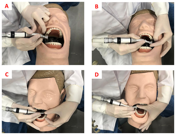 (A) Finger rests for cavity preparation on tooth 16. (B) Finger rests for cavity preparation on tooth 26. (C) Finger rests for cavity preparation on tooth 36. (D) Finger rests for cavity preparation on tooth 46.