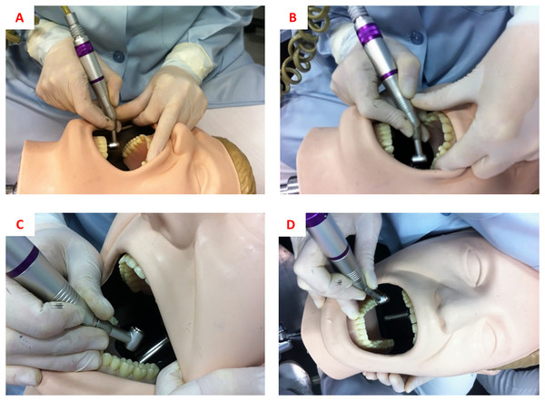 (A) Finger rests for cavity preparation on tooth 16. (B) Finger rests for cavity preparation on tooth 26. (C) Finger rests for cavity preparation on tooth 36. (D) Finger rests for cavity preparation on tooth 46.