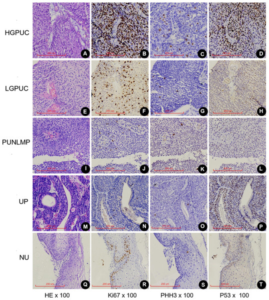 Expression of Ki67, PHH3 and P53 in different exophytic papillary urothelial neoplasms and normal urothelial tissues.