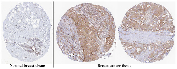 Representative images of immunohistochemical staining of normal breast (left panels) and breast cancer (right panels, Lobular carcinoma (F), Duct carcinoma (R)) from Human Atlas.