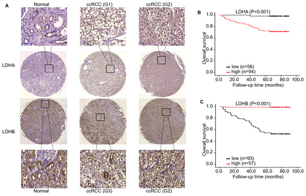 The expression and prognosis of both LDHA and LDHB in 150 ccRCC tissues.