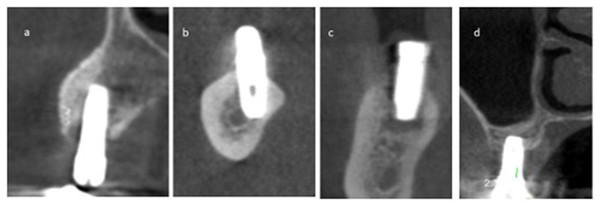The coronal view of a few CBCT scans that show the extent of CBL.