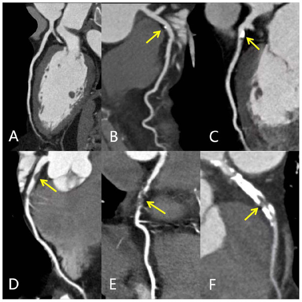 MPR images of different degrees of coronary artery stenosis.