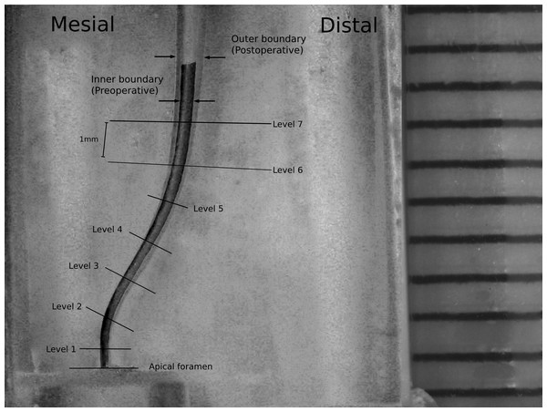 Superimposition of pre- and post-operative images of a representative canal model with double curvature and localization of the measuring levels.
