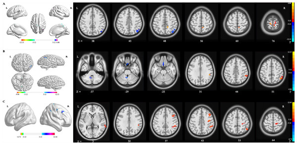 Brain regions with significant differences in dynamic ALFF.