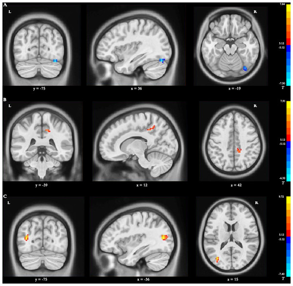 Brain regions with significant differences in dynamic ReHO.