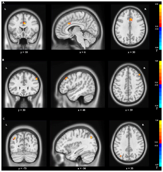 Brain regions with significant differences in dynamic DC.