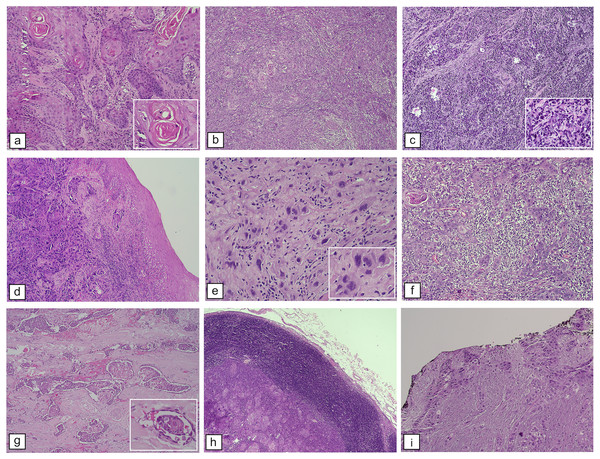 Histopathological features of OSCC. WHO histological differentiation.