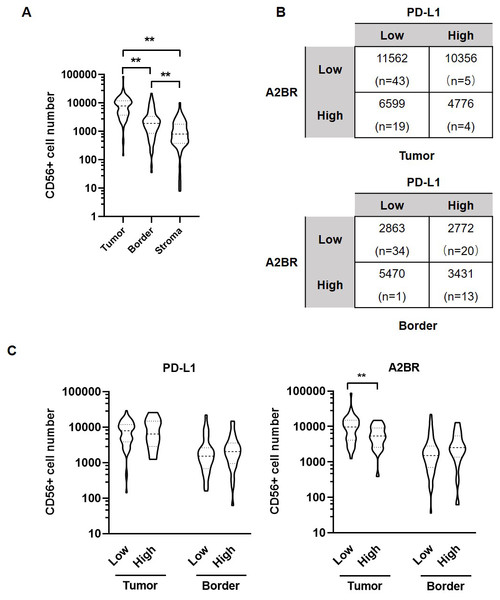 Adenosine 2b receptor (A2BR) and programmed death-ligand 1 (PD-L1) expression was associated with natural killer (NK) cell infiltration in oral squamous cell carcinoma (OSCC) tissues.