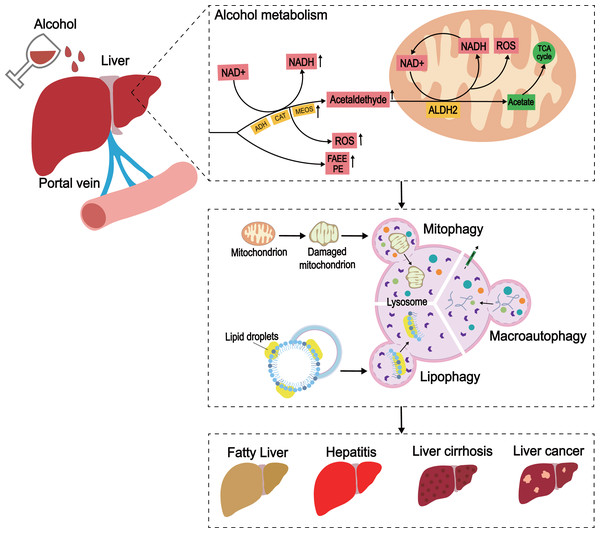 The development of ALD caused by excessive alcohol intake.