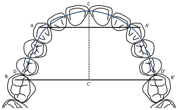 Dental arch measurements on plaster model.