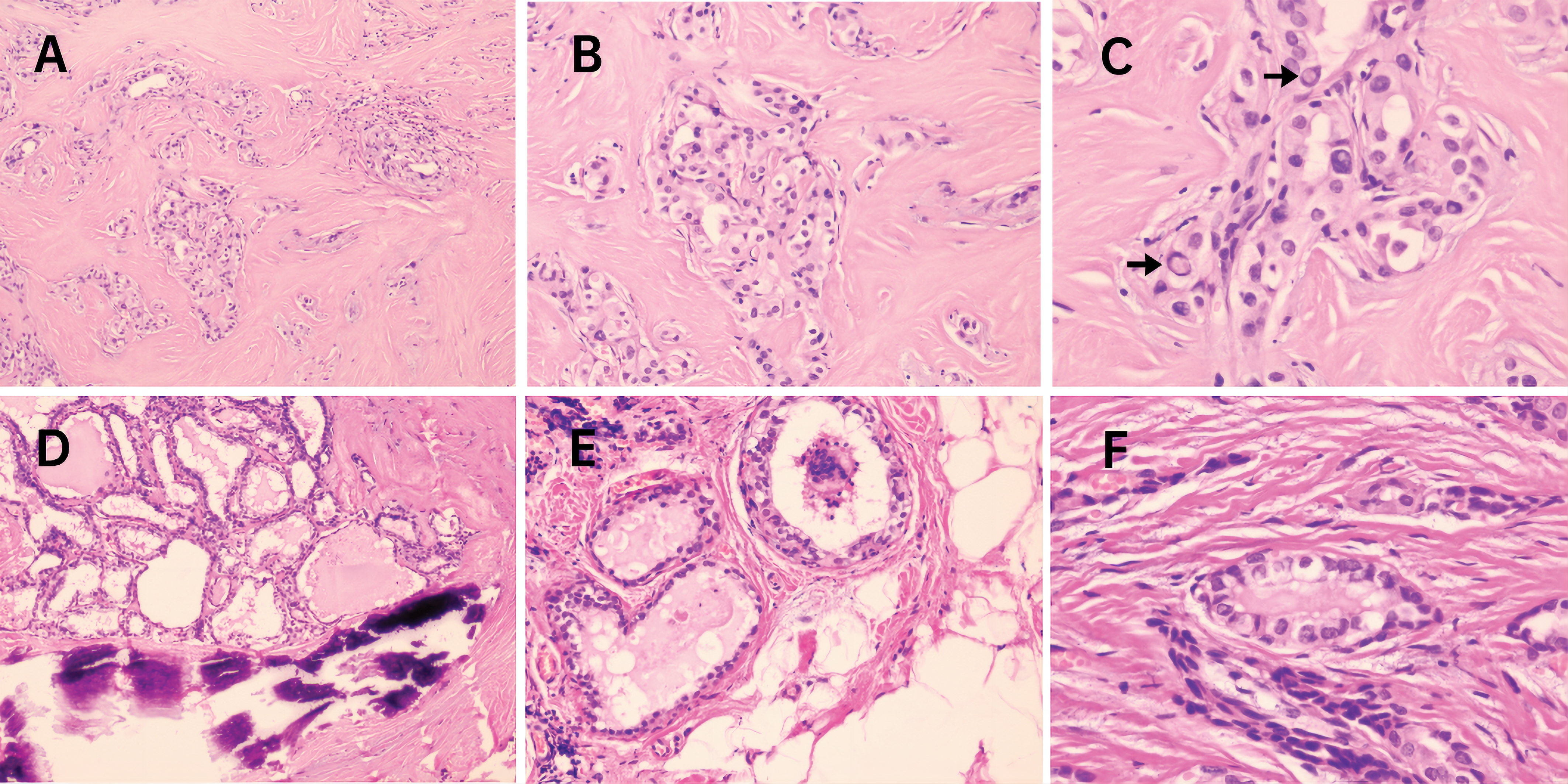 Molecular markers for the classification of cytologically indeterminate  thyroid nodules