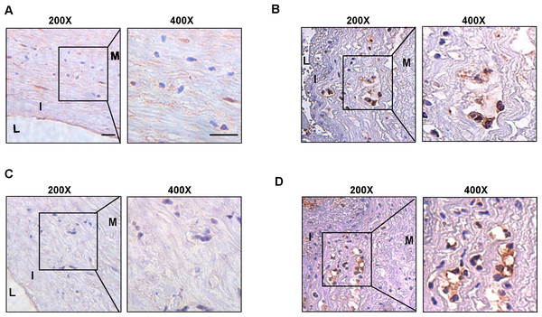 The expression level of CSF1R and PLAUR in the clinical samples.