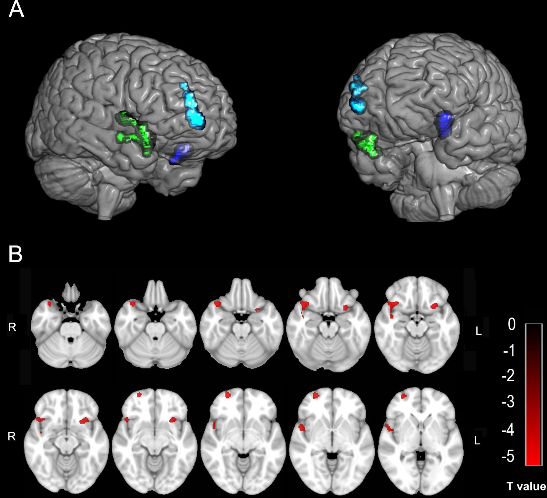 Frontiers  The brain-body disconnect: A somatic sensory basis for