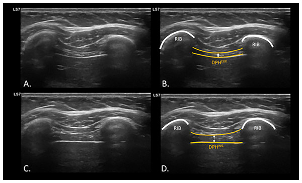 USI assessment and visualization of diaphragm thickening during expiration and inspiration.