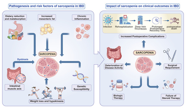 The pathogenesis and risk factors of sarcopenia in patients with IBD and impact of sarcopenia on clinical outcomes in IBD.