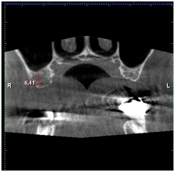 Residual bone high in the first molar region (6, 4 mm).